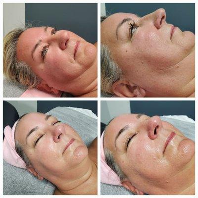 Hydrafacial