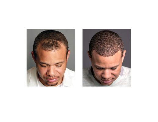 Bosley - Hair Restoration & Transplant - Denver