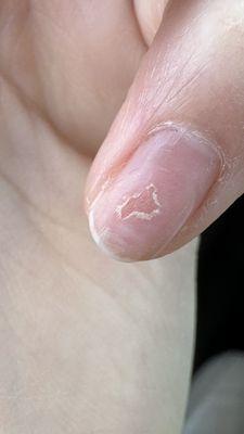 Damaged nails