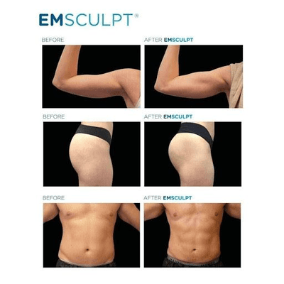 Get in Shape with EMSCULPT