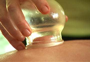 Hijama , wet cupping