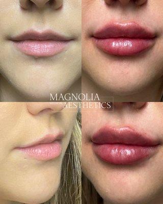 Before & After lip filler. Patient requested ultra plump lips.