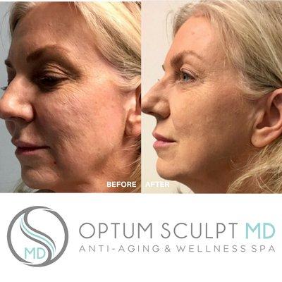 non-surgical facelift with filler