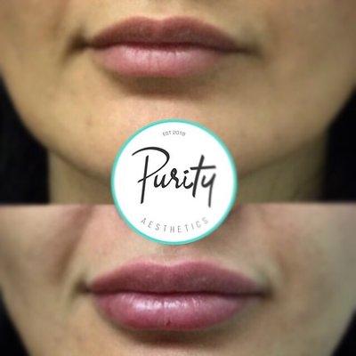 Lips fillers. Volbella. Natural looking lips