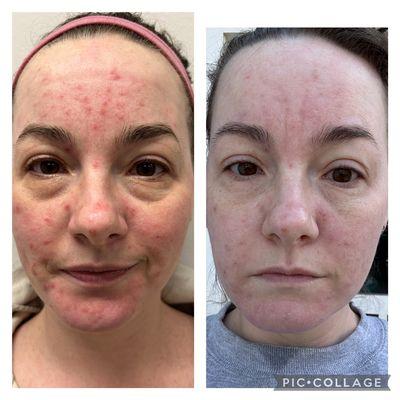 My Heart! As someone who has struggled with Acne, I felt for her. This is literally 3 days post 1 IPL Acne Away Treatment! Let me help you!