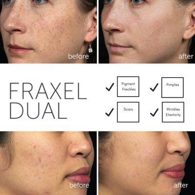 Fraxel dual for simultaneous treatment of scars, pores, and pigments.