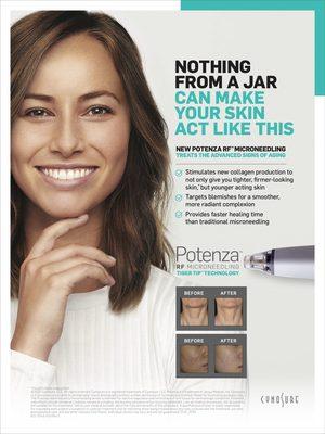 The new standard in RF micro needling, Potenza!