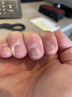 Look at the peeling polish from each nail!