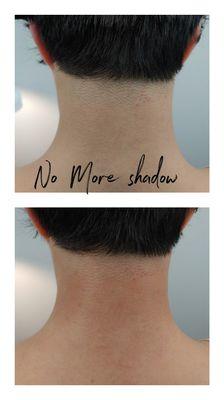 Back of the neck treatment. We are not done treating with this area but even after 1 session,  no more shadow..