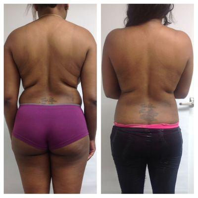 Lipo-Sculpt Lite- Fat Reduction