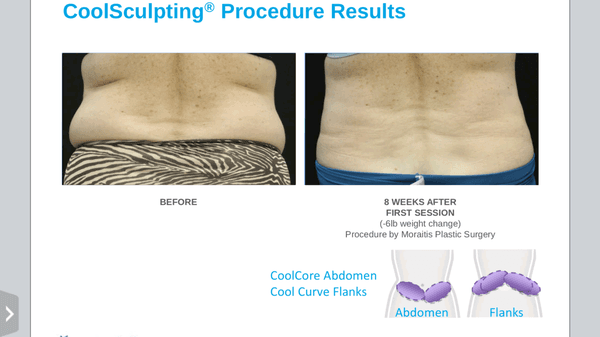 Coolsculpting of the flanks by Moraitis Plastic Surgery