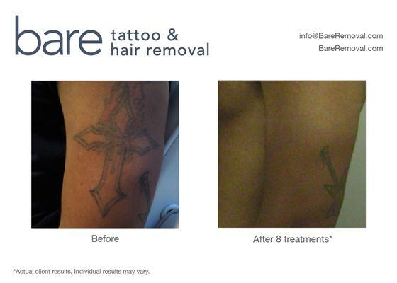 Complete laser tattoo removal on African American skin by Bare Tattoo & Hair Removal.