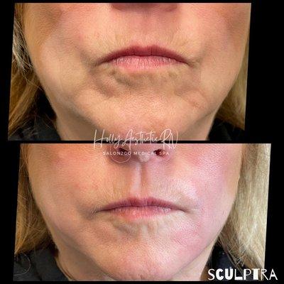 Sculptra-increasing collagen & Elastin Production