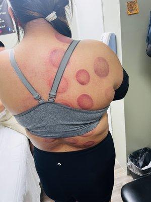 Cupping, included with our membership