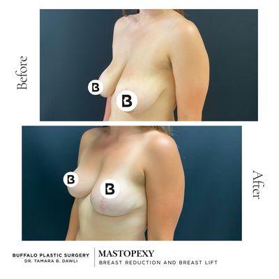 mastopexy