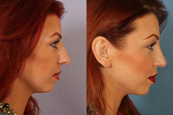 Rhinoplasty (Nose Job)