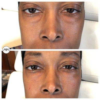 Under eye fillers for large eye bags!