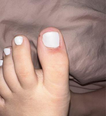 Bad pedicure, injured toe due to nail tech