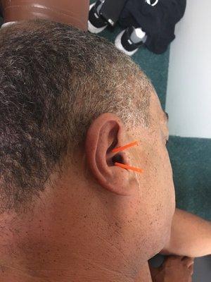 Ear acupuncture