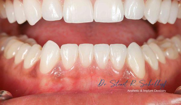 Lower veneers to allow this patient the smile of her dreams!