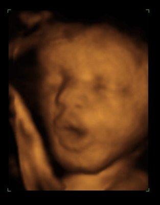 3D Ultrasound Photo