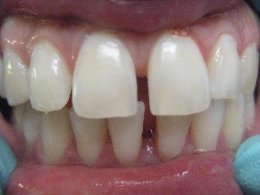 Veneers - Before