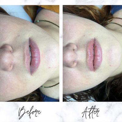 Before & After Hyaluron Lip Filler