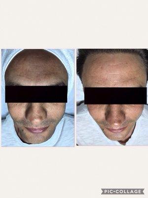 Dermabrasion facial before and after