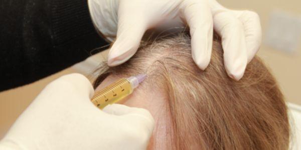 we use multiple modalities to treat Alopecia (hair fall/loss)