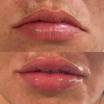 Plump lips are right around the corner! Book your appointments today!