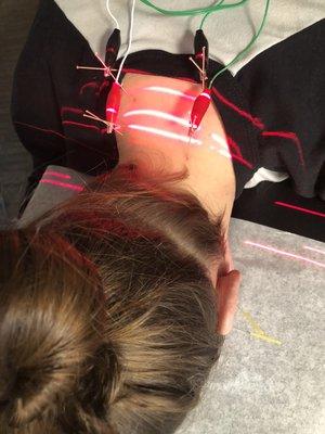 Cold laser and Medical acupuncture!