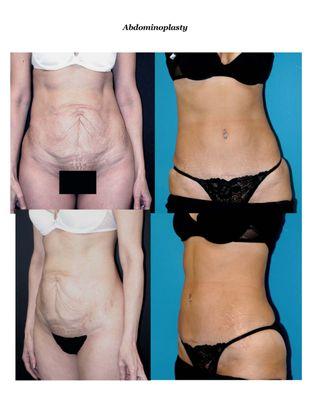 Abdominplasty with removal of excess skin