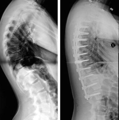 Scheureman's kyphosis correction