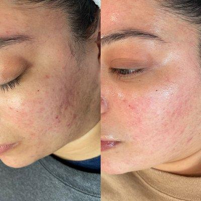 Before and after of a series of 6 chemical peels for texture,acne scares and redness