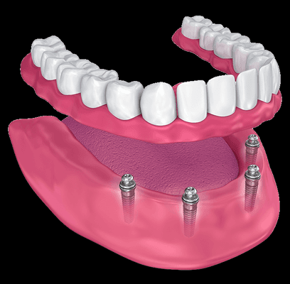 IMPLANT SUPPORTED DENTURES