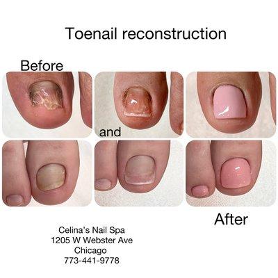 Toenail reconstruction