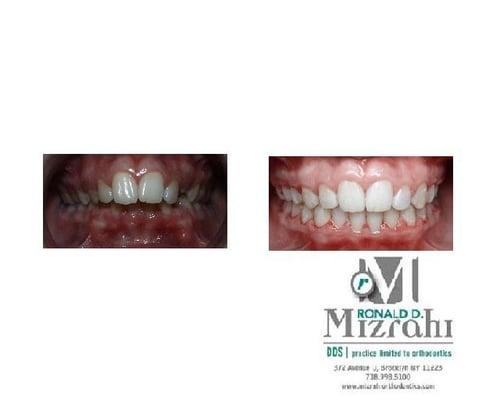 Dr. Mizrahi does it as usual, a GREAT new smile