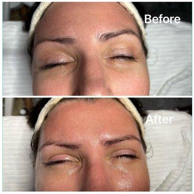 No-Needle Mesotherapy Facial