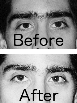 He once had a unibrow. Now he's more attractive.