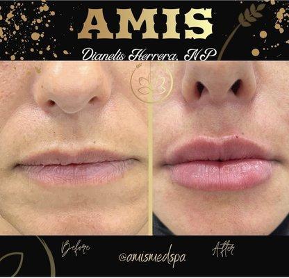 Done with 0.4ml of HA filler on lips and 0.3ml on nasolabial folds. Lips and nasolabial folds restored and refined. Only @amismedspa.