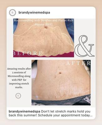 Stretch marks removal