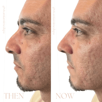 Liquid Rhinoplasty