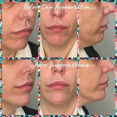 Chin Augmentation with Juvederm