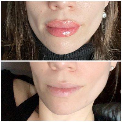 Before and immediately after lip blushing