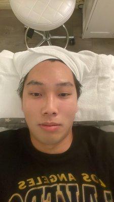 Post-acne treatment