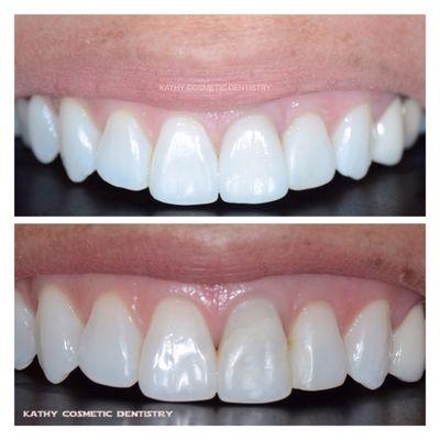 Aesthetic restorative dentistry was performed to enhance the smile line.