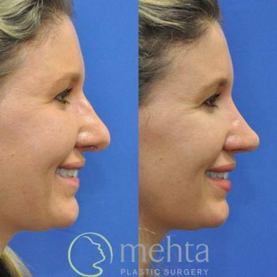 Rhinoplasty before (left) and after (right)