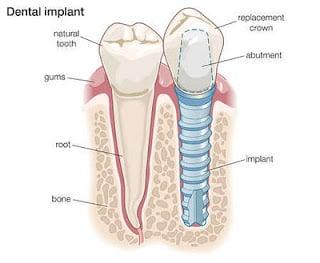 implant crowns