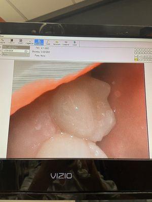 This is the tooth after the procedure! It looks amazing!