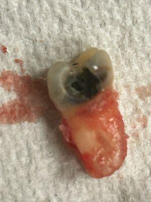 Bad decay and not being responsible tooth extraction